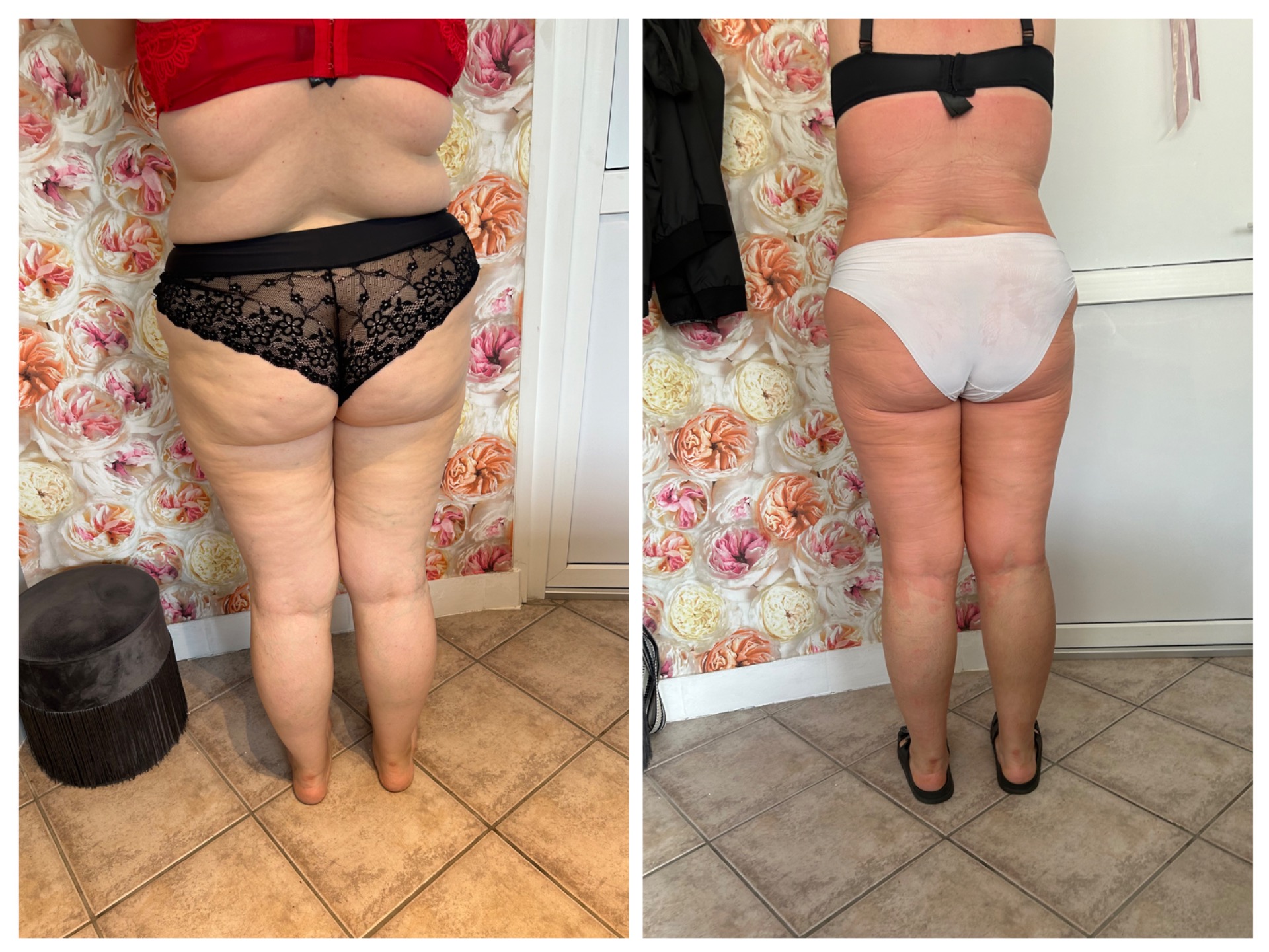 4 hét eredmény: Wiener aromaterápiás testtekercselés és HiemT kombinációja