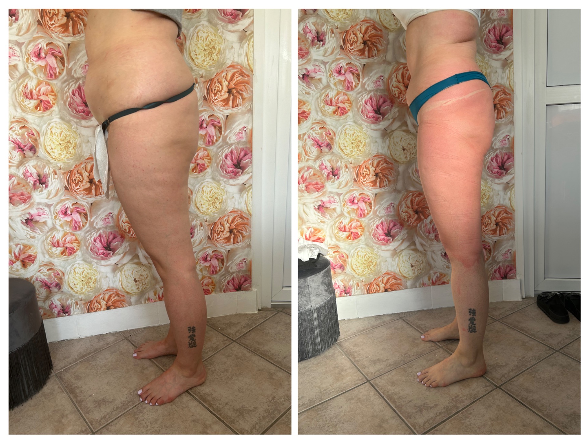 6 hèt eredménye: 8 alkalom kavitációs zsírbontàs, és 8 alkalom Wiener aromaterápiás testtekercselés