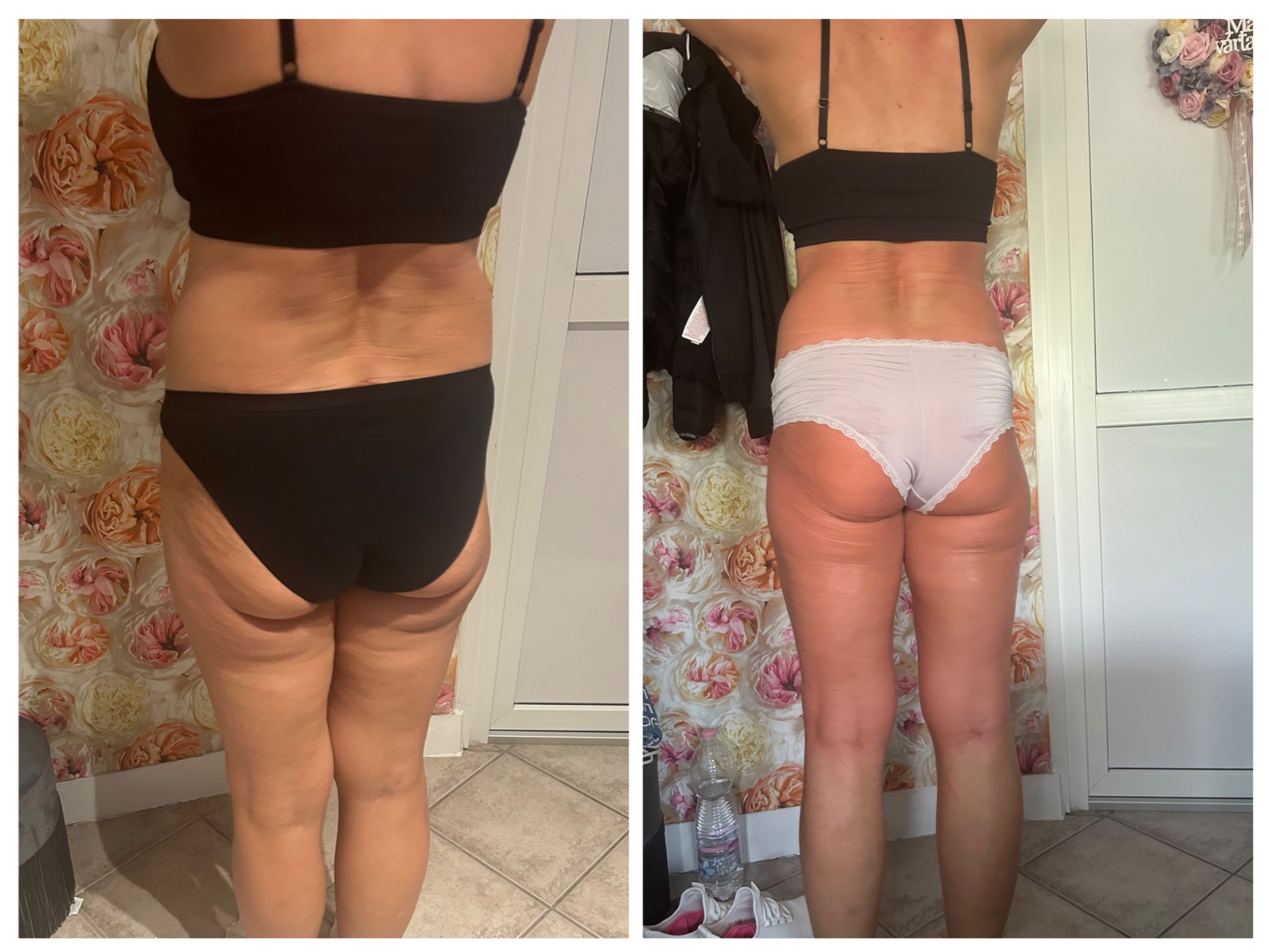 8 hét eredménye: 8 alkalom kavitációs zsírbontás, 8 alkalom Wiener aromaterápiás testtekercselés